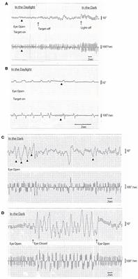 Case report: Saccadic ping-pong gaze in progressive supranuclear palsy with predominant postural instability